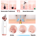 Removedor de Cravos e Espinhas a Vácuo Beauty Clean