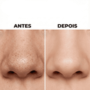 Removedor de Cravos e Espinhas a Vácuo Beauty Clean